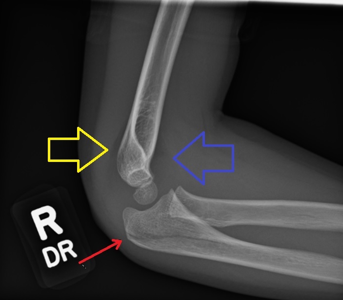 Paeds Trauma iSAWE 20, lateral radiograph of the elbow