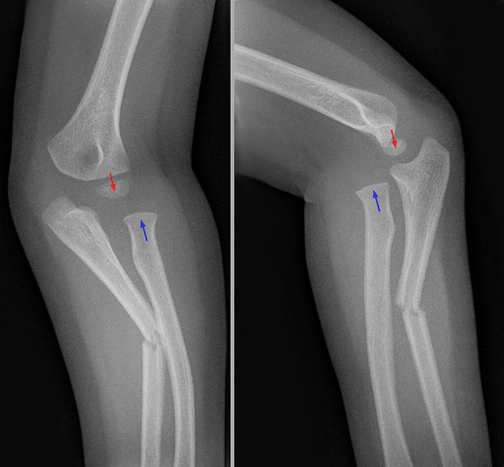 Paeds Trauma iSAWE 3, ap and lateral radiographs of the forearm and elbow