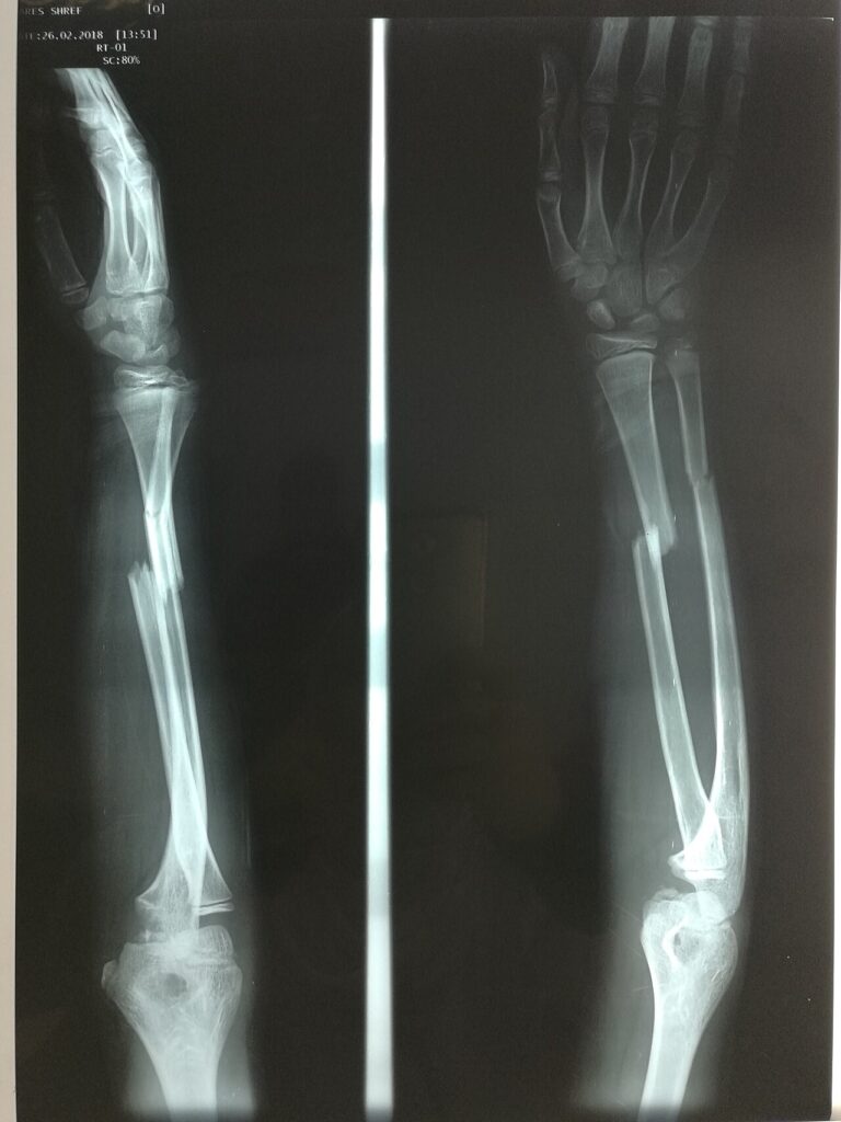 Paeds Trauma iSAWE 4, radiographs of the forearm