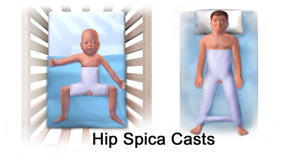 Paeds Trauma iSAWE 5, hip spica casts in a child and an adult