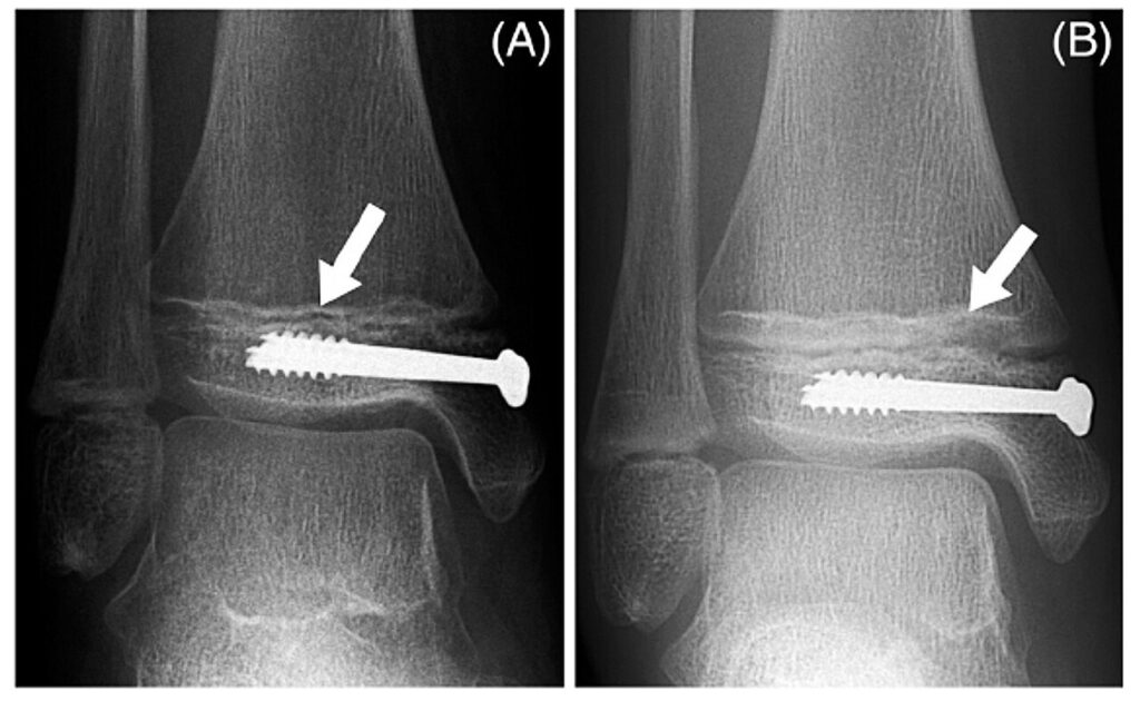 Paeds Trauma iSAWE 8, anteroposterior radiographs of the ankle