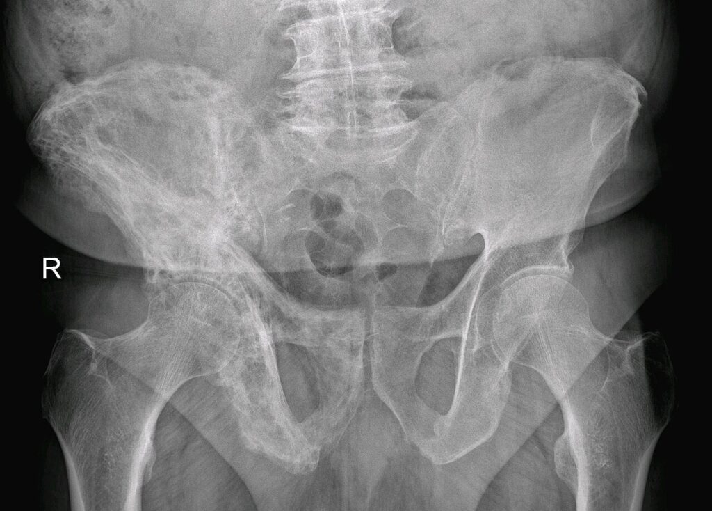 Tumour iSAWE 11, radiograph of the pelvis