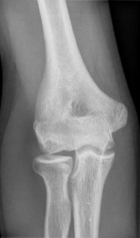 Panner's, radiograph of panner disease of the capitellum