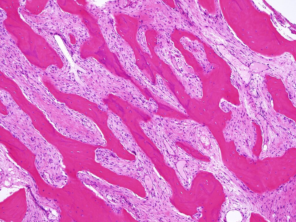 Parosteal Osteosarcoma, histology of parosteal osteosarcoma