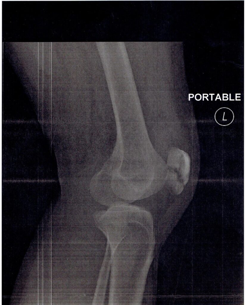 Knee iSAWE 11, lateral radiograph of the knee