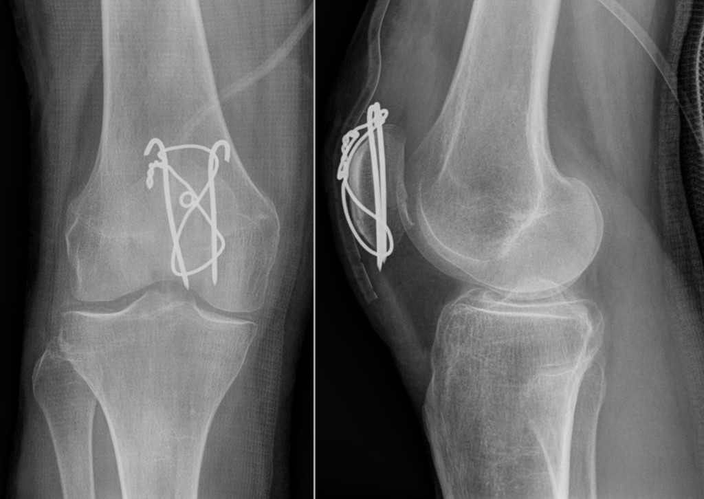 Patellar Fractures, tension band wiring of a transverse patella fracture