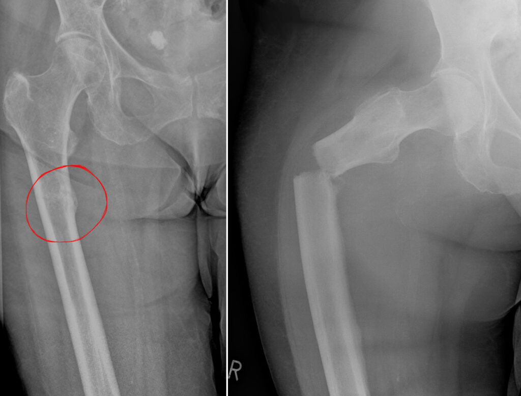 Tumour iSAWE 18, radiographs of the proximal femur
