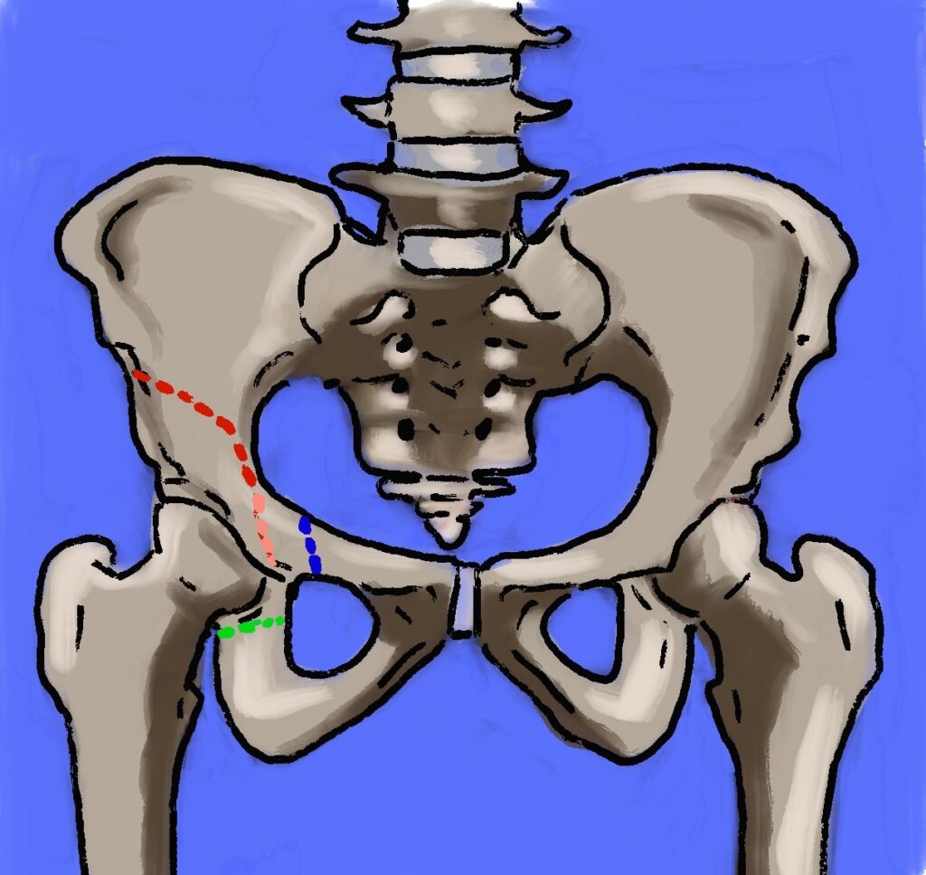 Pelvic Osteotomies, schematic of a periacetabular osteotomy