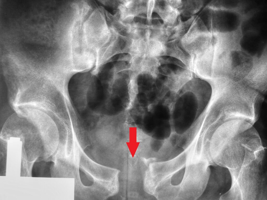 Hip iSAWE 14, AP radiograph of the pelvis