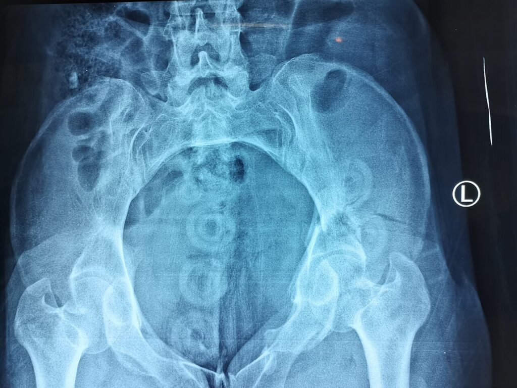 Pelvic Trauma, inlet view of the pelvis showing a fracture of the left ischium