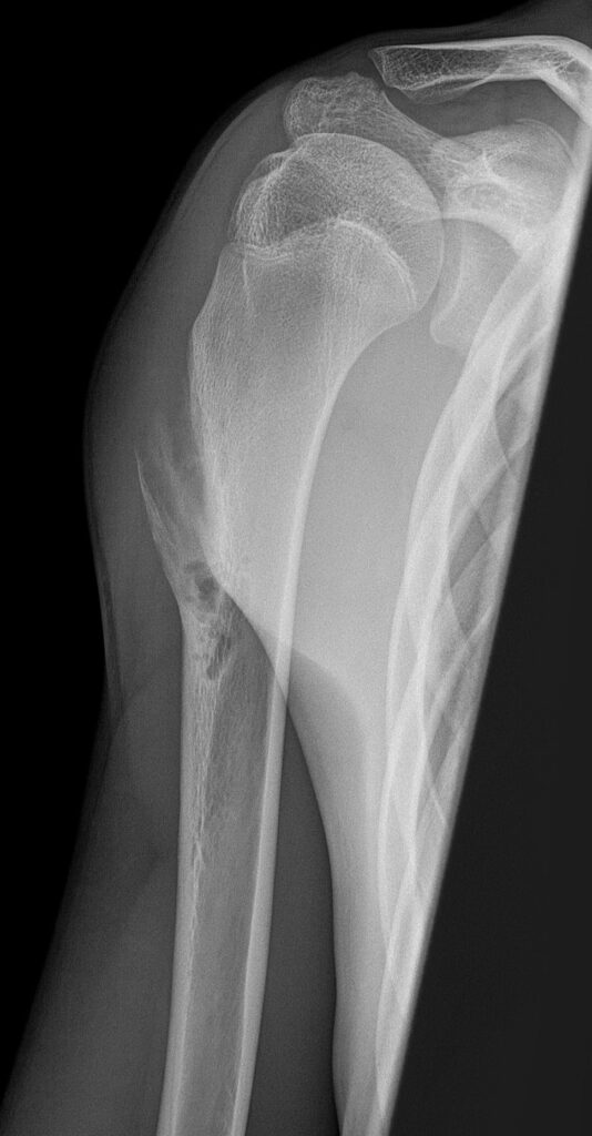 Periosteal Chondroma, radiograph of a periosteal cartilage tumour (periosteal chondroma or low grade chondrosarcoma)