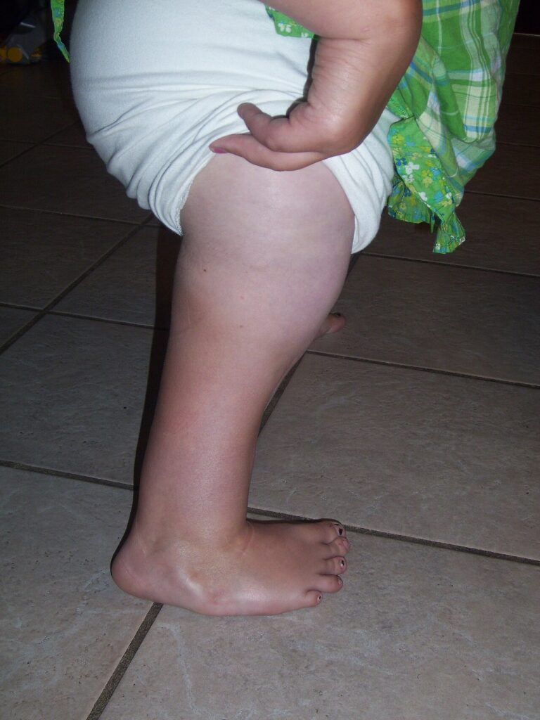 PFFD | Proximal Femoral Focal Deficiency, clinical photograph of proximal femoral focal deficiency
