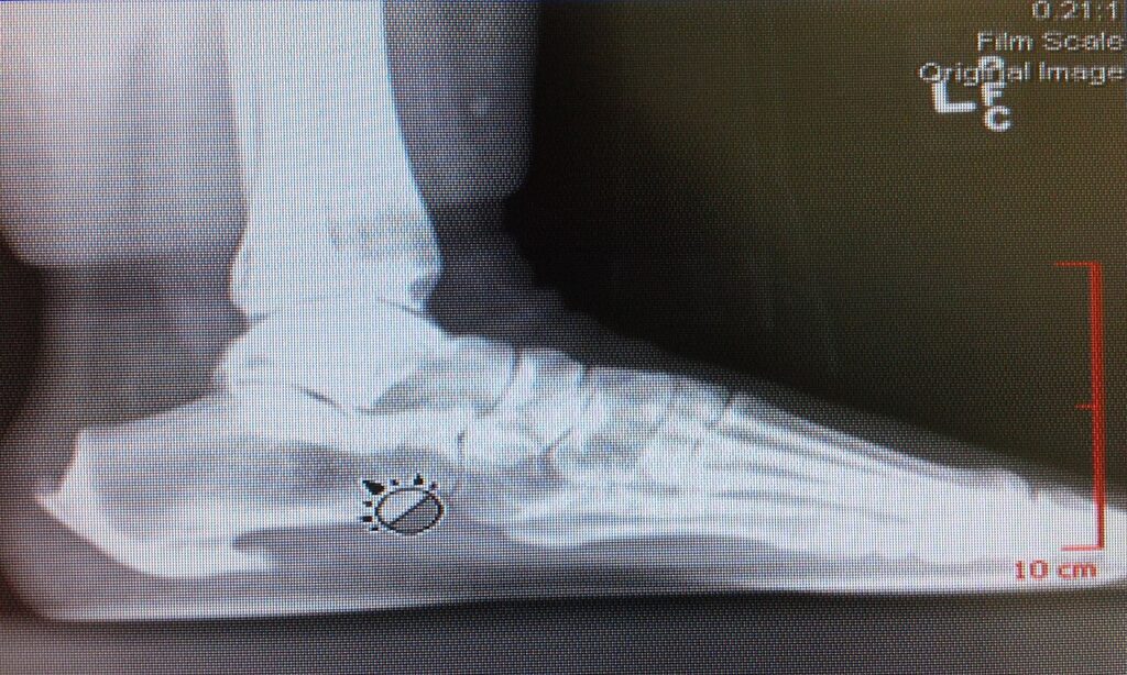 Foot Ankle iSAWE 16, lateral radiograph of the foot
