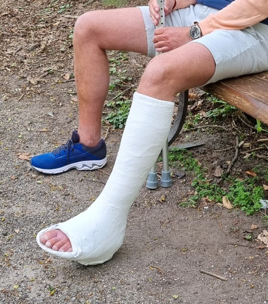 Plaster of Paris / Closed Fracture Management, plaster of paris short leg walking cast