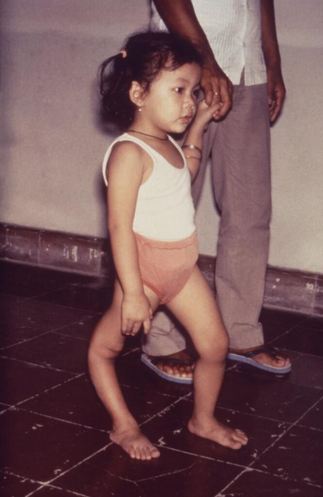 Polio, lower limb sequelae of poliomyelitis