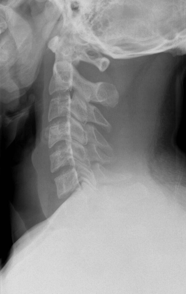 Posterior Approach to the Cervical Spine, lateral radiograph of the cervical spine
