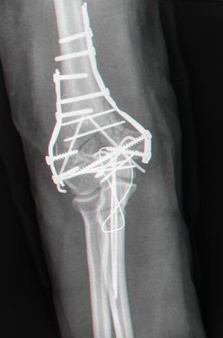 Posterior Approach (Using Olecranon Osteotomy), radiograph of a distal humerus fracture after fixation