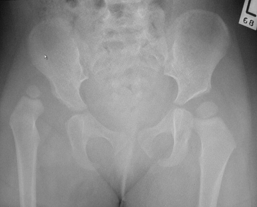 Hip iSAWE 13, AP radiograph of the pelvis