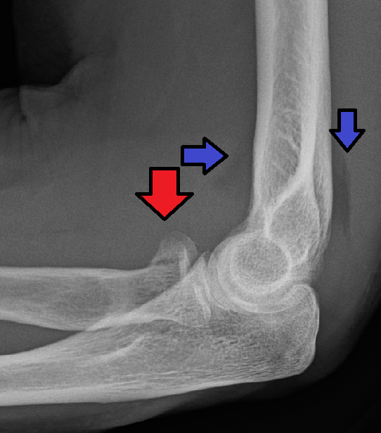 Shoulder Elbow iSAWE 16, lateral radiograph of the elbow
