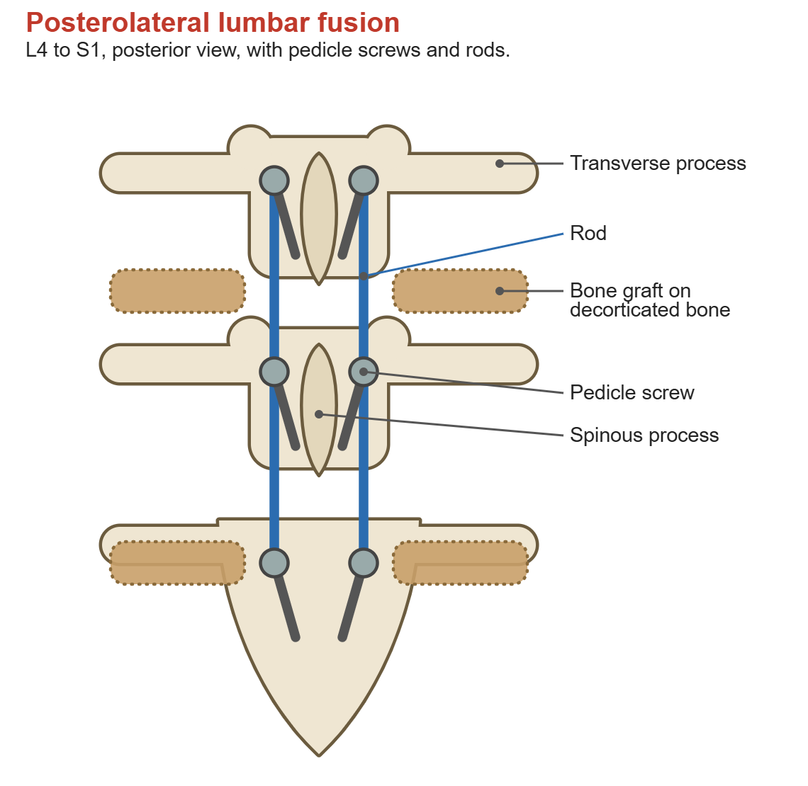 Posterior view of the lower lumbar spine and sacrum with pedicle screws and rods from L4 to S1, and bone graft laid on the decorticated transverse processes