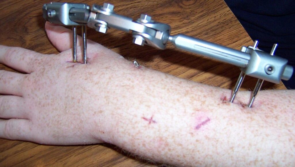 Principles of External Fixation, external fixator applied to the forearm