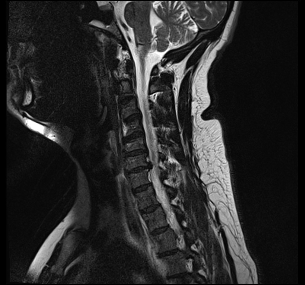 Spine iSAWE 15, sagittal T2 MRI of the cervical spine