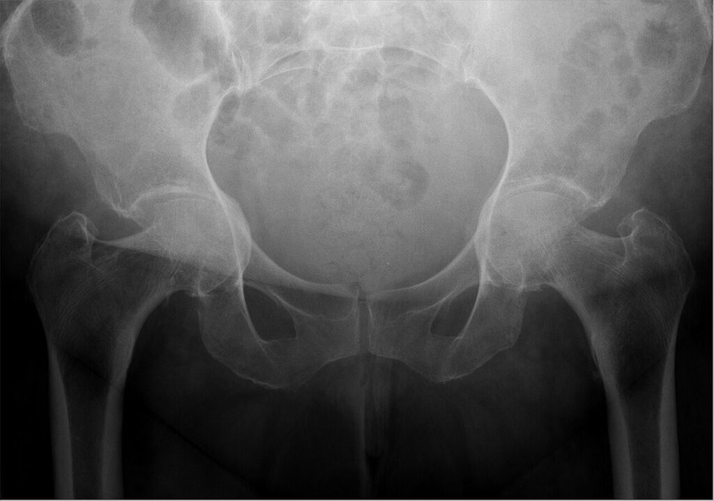Hip iSAWE 10, ap radiograph of the pelvis