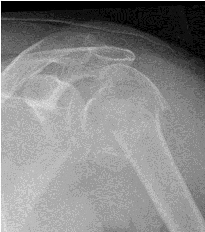 Proximal Humeral Fractures, radiograph of a complex proximal humerus fracture