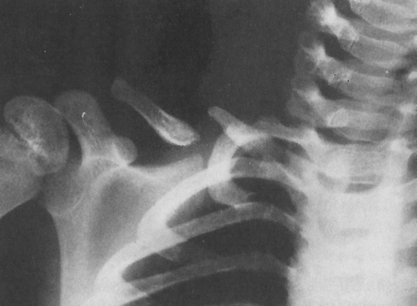 Pseudoarthrosis of the Clavicle, radiograph of congenital pseudarthrosis of the clavicle