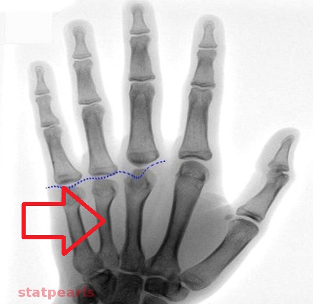 Pseudohypoparathyroidism, hand radiograph in pseudohypoparathyroidism showing shortened metacarpals