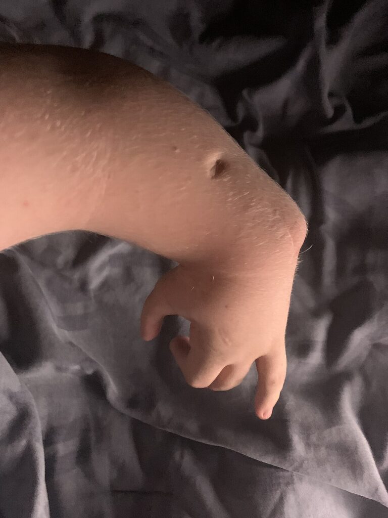 Paeds Elective iSAWE 19, clinical photograph of the forearm and hand