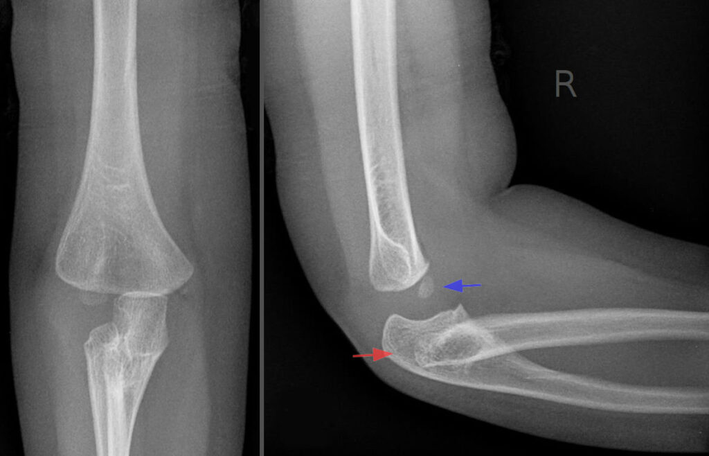 Radial Head Dislocation, radiograph of a congenital radial head dislocation