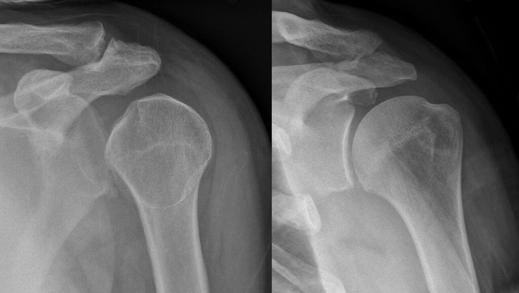 Shoulder Elbow iSAWE 10, ap radiograph of the shoulder