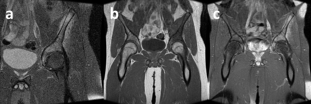 Tumour iSAWE 19, coronal MRI of the pelvis