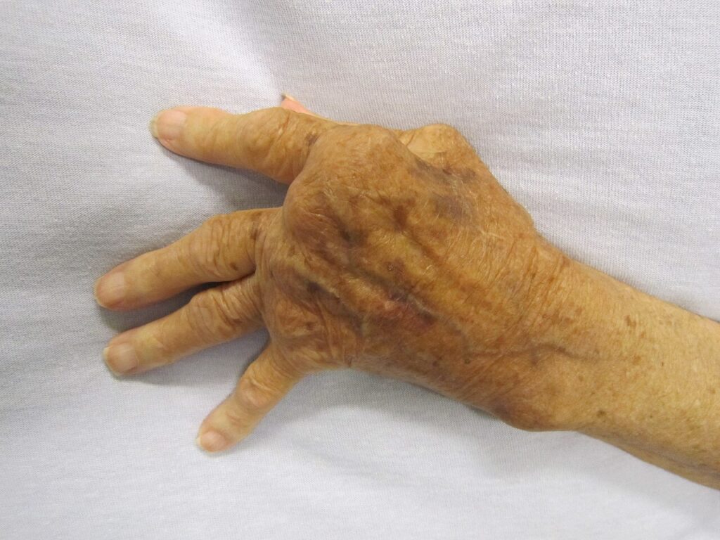 Rheumatoid Arthritis Epidemiology, hand deformity in rheumatoid arthritis
