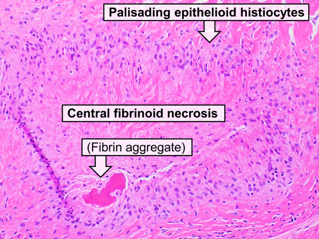 Rheumatoid Arthritis Epidemiology, histopathology of a rheumatoid nodule