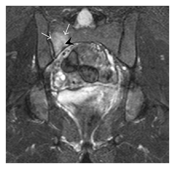 Spine iSAWE 19, coronal inversion recovery MRI of the pelvis