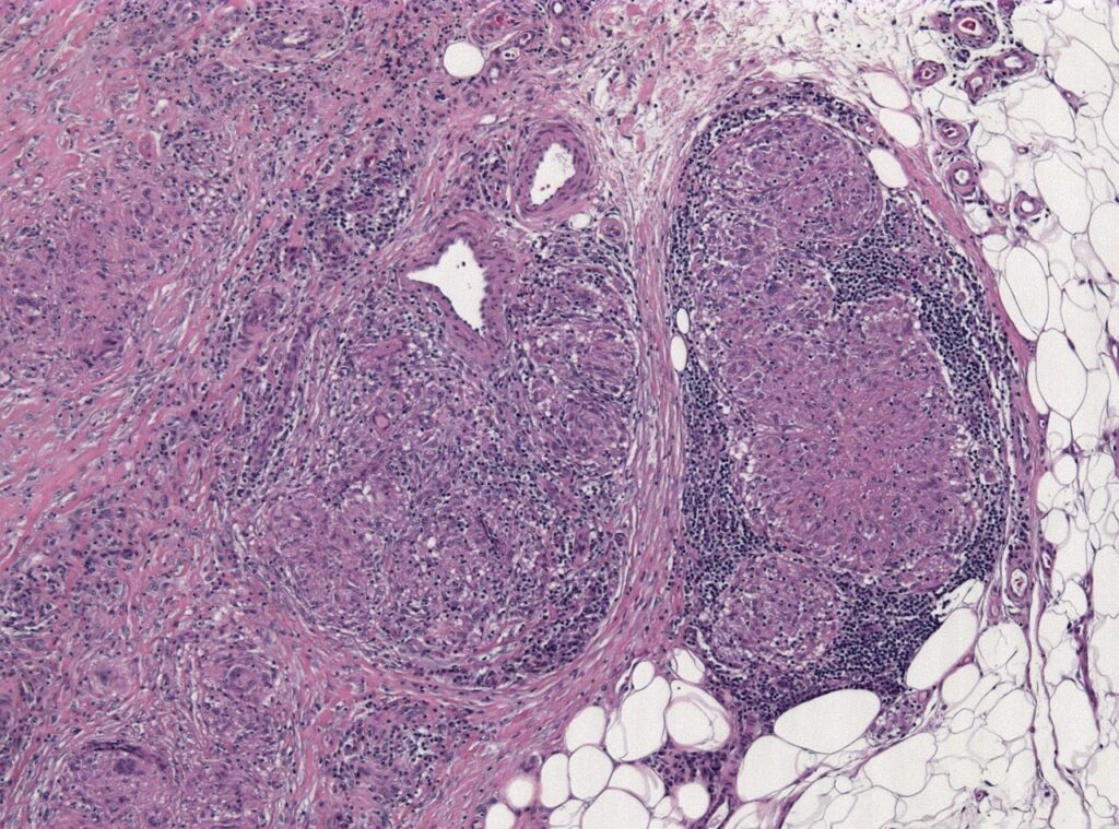 Sarcoidosis, histology of non-caseating sarcoid granulomas