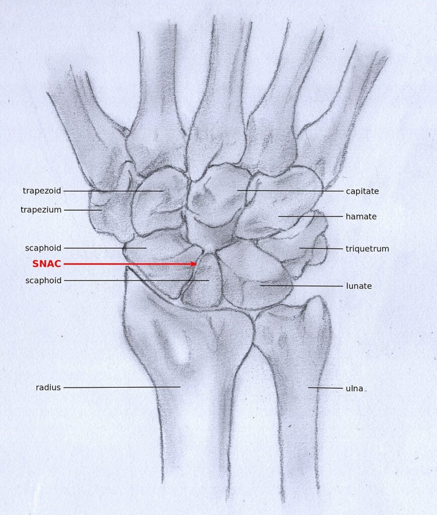 Scaphoid ± Bone Graft, diagram of scaphoid nonunion advanced collapse (snac)