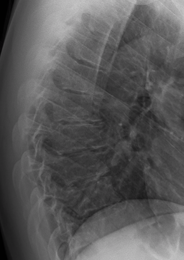 Spine iSAWE 10, lateral imaging of the thoracic spine