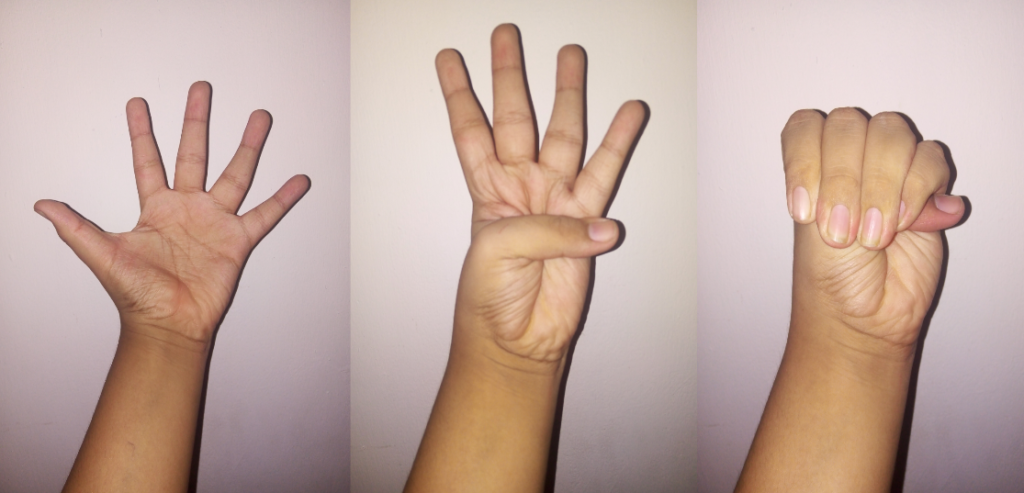Scoliosis in Marfan Syndrome, steinberg thumb sign in marfan syndrome