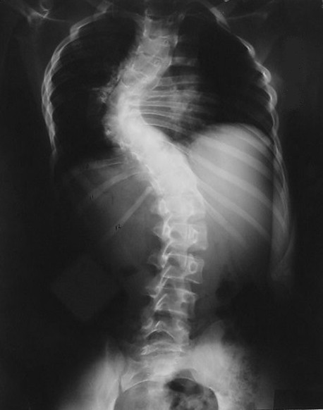 Scoliosis in Neurofibromatosis, radiograph of scoliosis in neurofibromatosis
