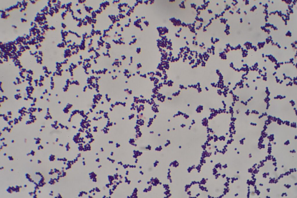 Septic Arthritis, gram stain of staphylococcus aureus, the most common cause of septic arthritis