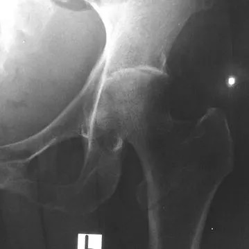 Septic Arthritis, radiograph of the left hip in septic arthritis caused by melioidosis
