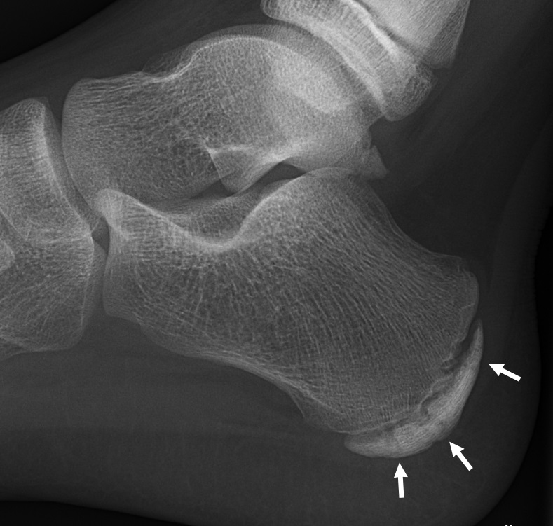 Sever's, radiograph showing sclerosis and fragmentation of the calcaneal apophysis in sever disease