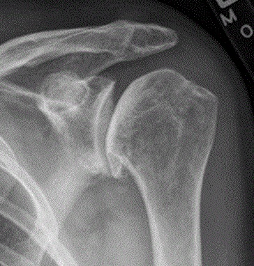 Shoulder Arthritis, radiograph of glenohumeral osteoarthritis
