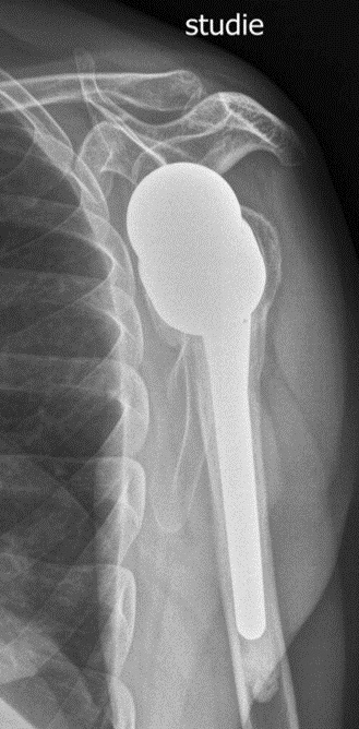Arthroplasty iSAWE 7, radiograph of the shoulder