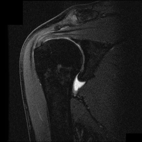 Shoulder Elbow iSAWE 1, coronal mri of the shoulder