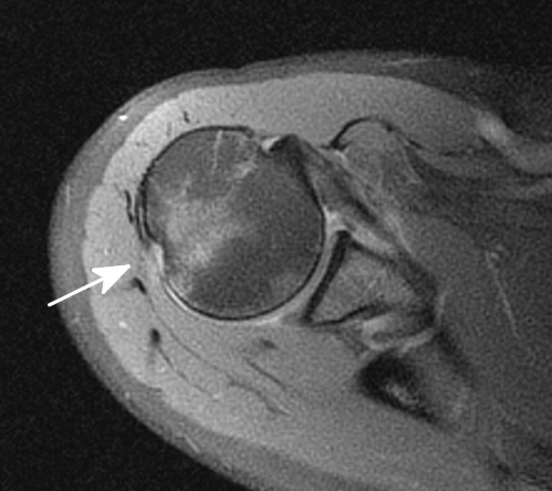 Shoulder Elbow iSAWE 2, axial mri of the shoulder