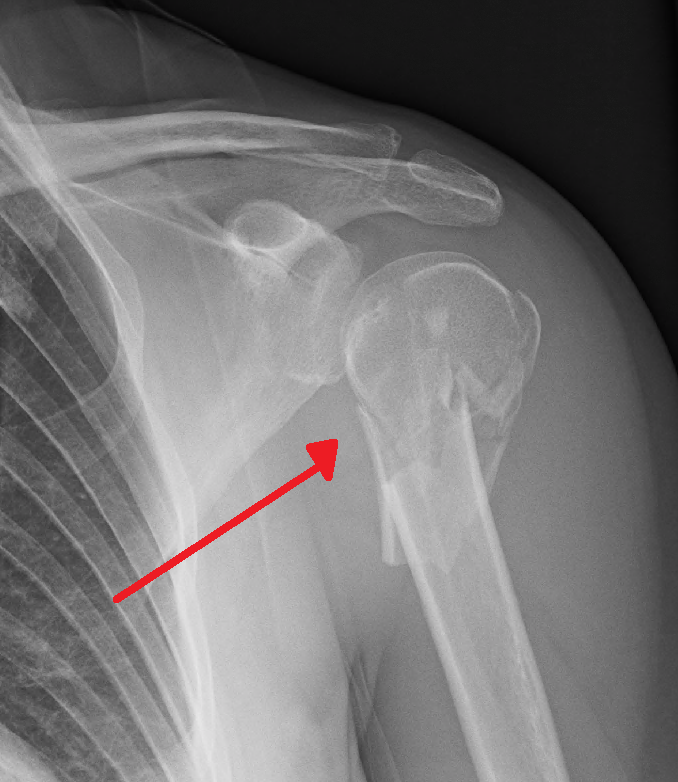 Shoulder Elbow iSAWE 4, ap radiograph of the shoulder
